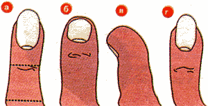 Анализ фаланг большого пальца